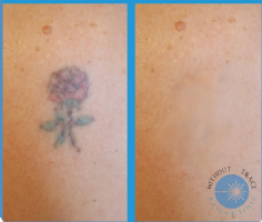 Without A Trace Laser Clinic Photo